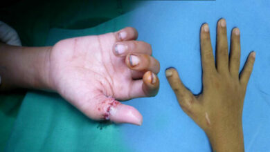 หมอผ่าตัดนิ้วโป้ง หัวแม่มือ