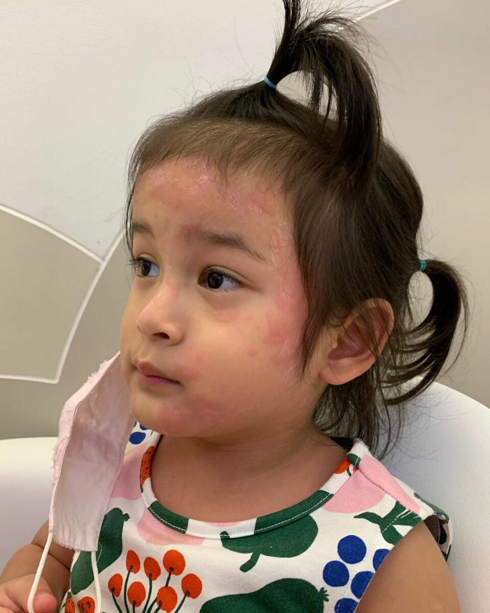 มียา ลมพิษ