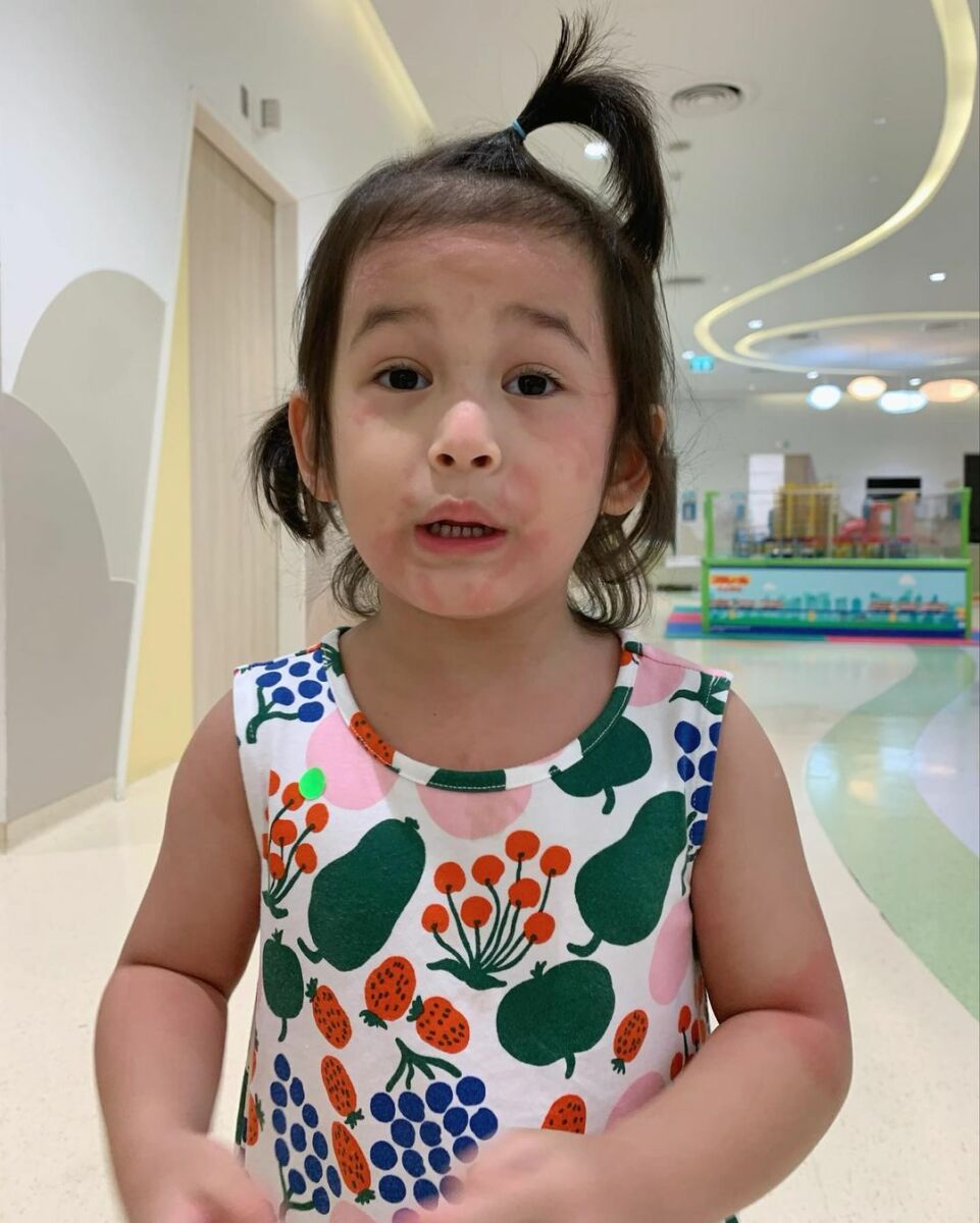 มียา ลมพิษ