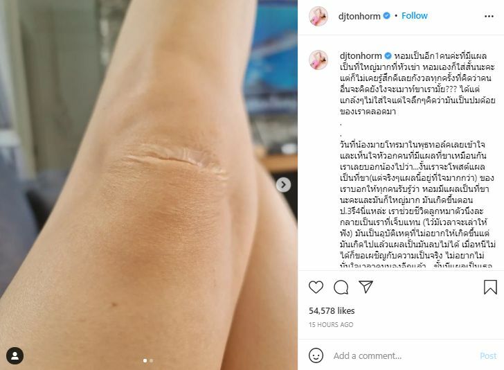 ดีเจต้นหอม แผลเป็น