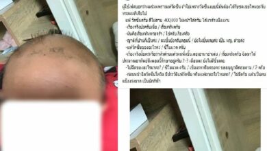 ผมร่วง ฉีดวัคซีน