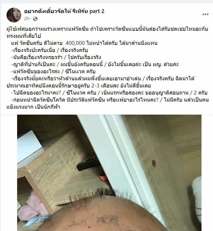 แพ้วัคซีน ผมร่วง