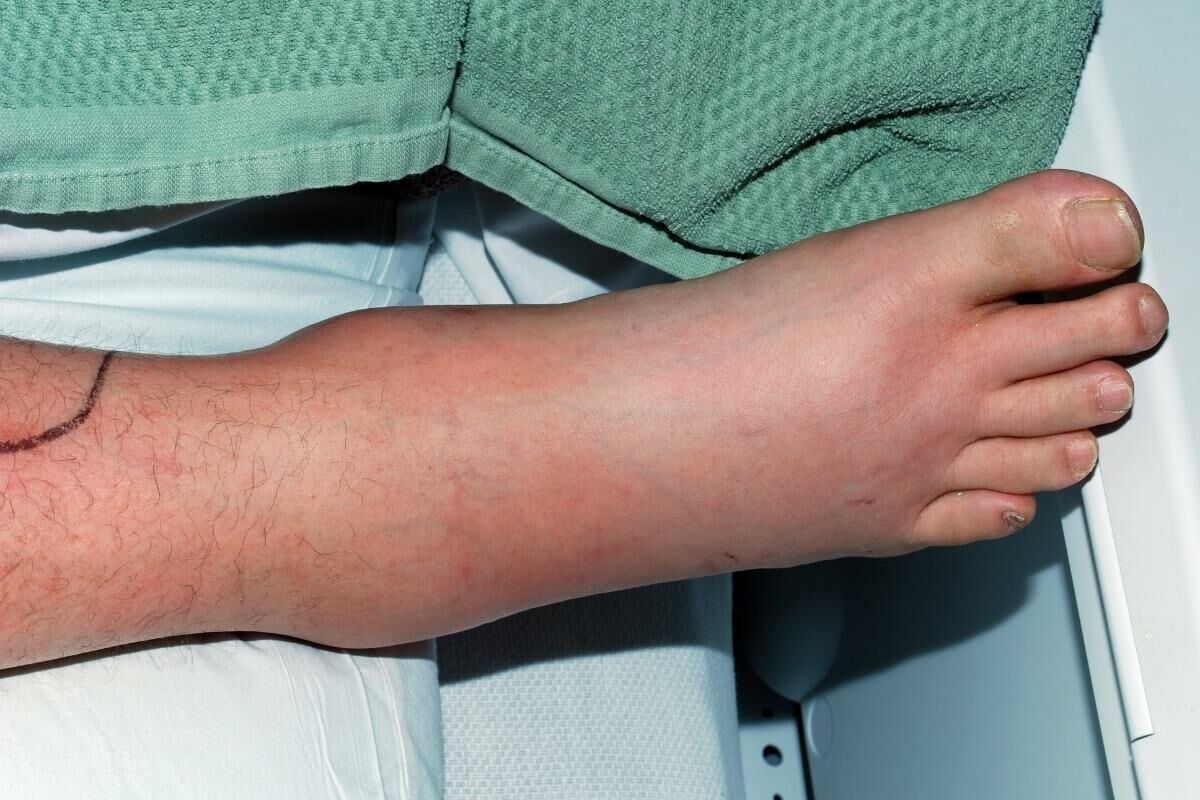 อาการตัวบวม