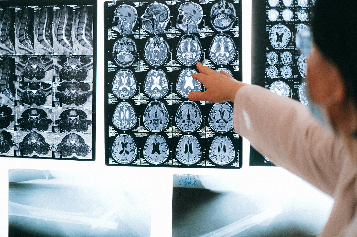 อาการ ภาวะของโรค aphasia 