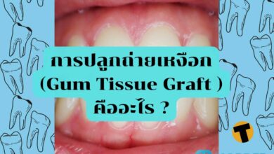 การปลูกถ่ายเหงือก (Gum Tissue Graft ) คืออะไร ?