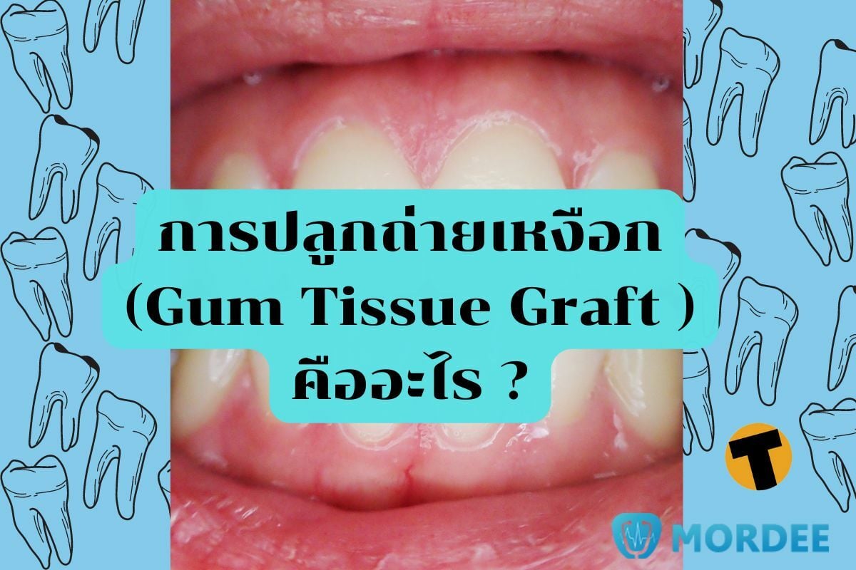 การปลูกถ่ายเหงือก (Gum Tissue Graft ) คืออะไร ?