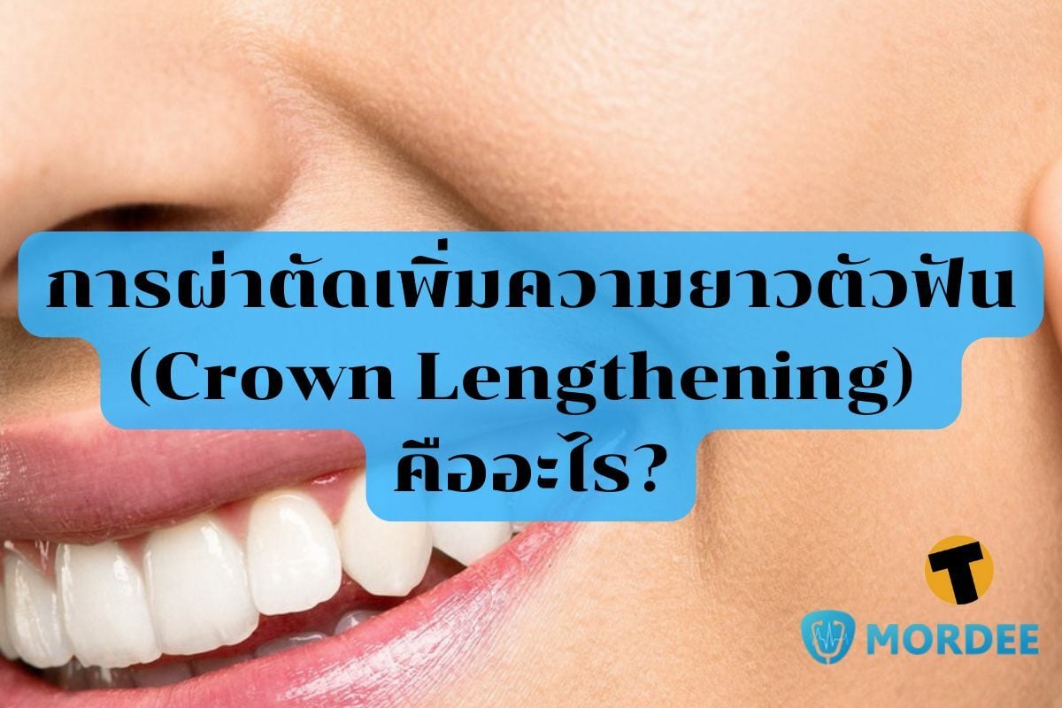 การผ่าตัดเพิ่มความยาวตัวฟัน (Crown Lengthening) คืออะไร?