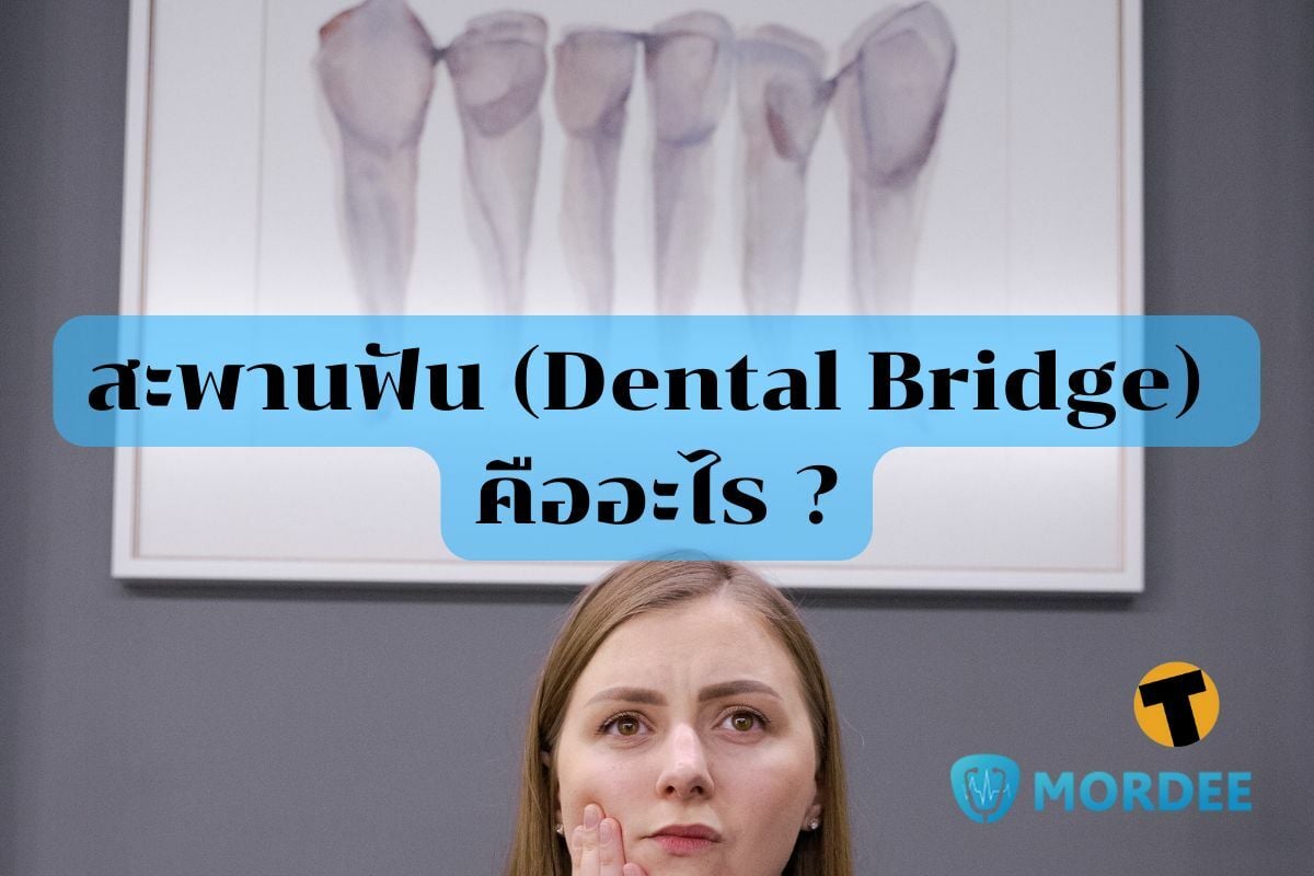 สะพานฟัน (Dental Bridge) คืออะไร ?