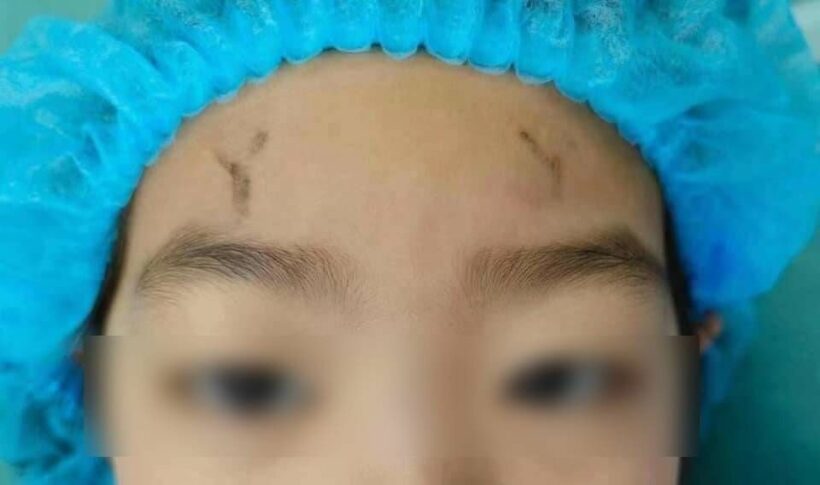 เด็กเวียดนาม ศัลยกรรม