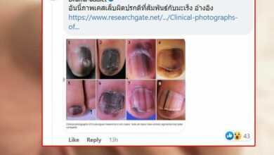 เล็บบอกโรคมะเร็ง