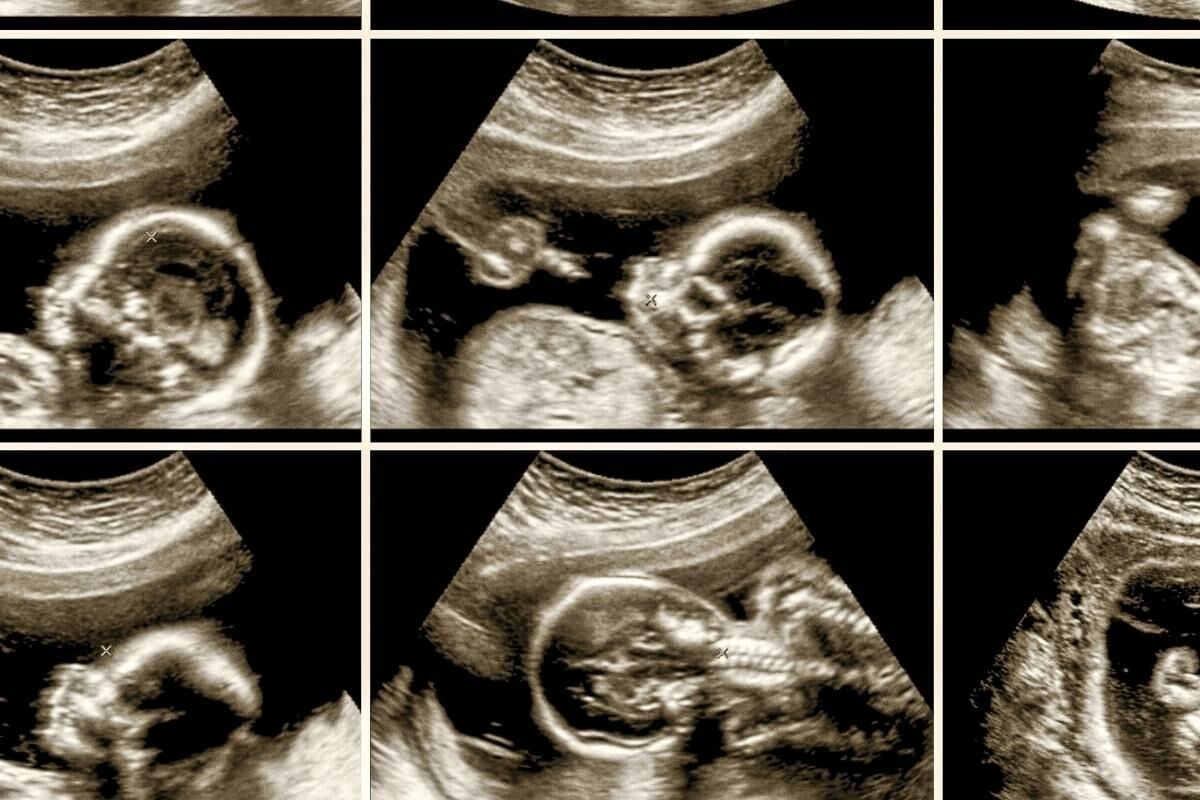 ฝันว่าแท้งตอนตั้งครรภ์