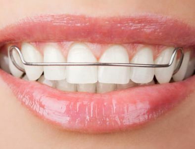 รีเทนเนอร์ แบบลวด