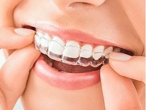 ขี้เกียจใส่รีเทนเนอร์ Invisalign