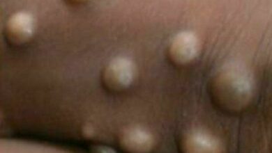 ฝีดาษลิง