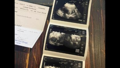 ซีสต์ในรังไข่