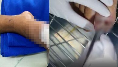 พาพ่อไปรักษาเล็บขบ หนอนไชนิ้ว