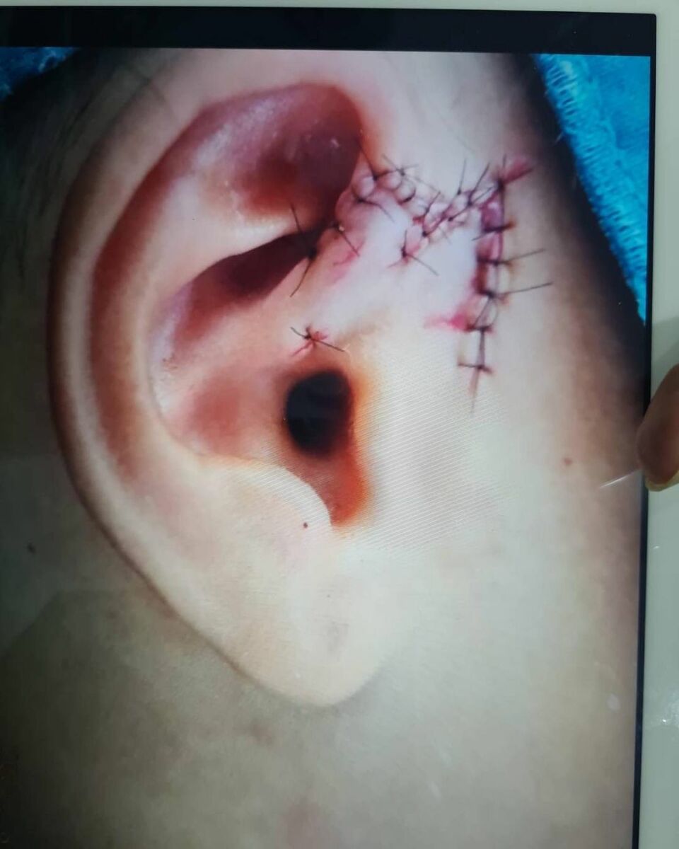 น้องเอเดนล้มหูกระแทกขอบเตียง