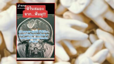 ฝีในสมอง ฟันผุ