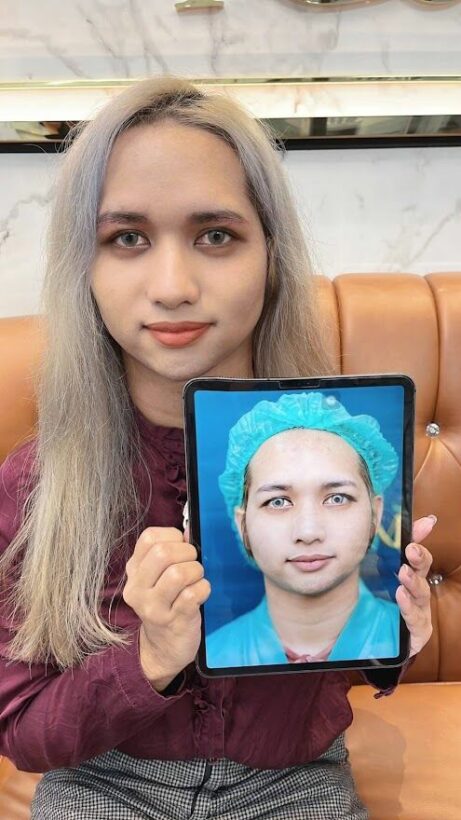 ยกหางตา หลังทำ