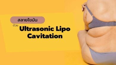 สลายไขมัน ด้วย Ultrasonic Lipo Cavitation