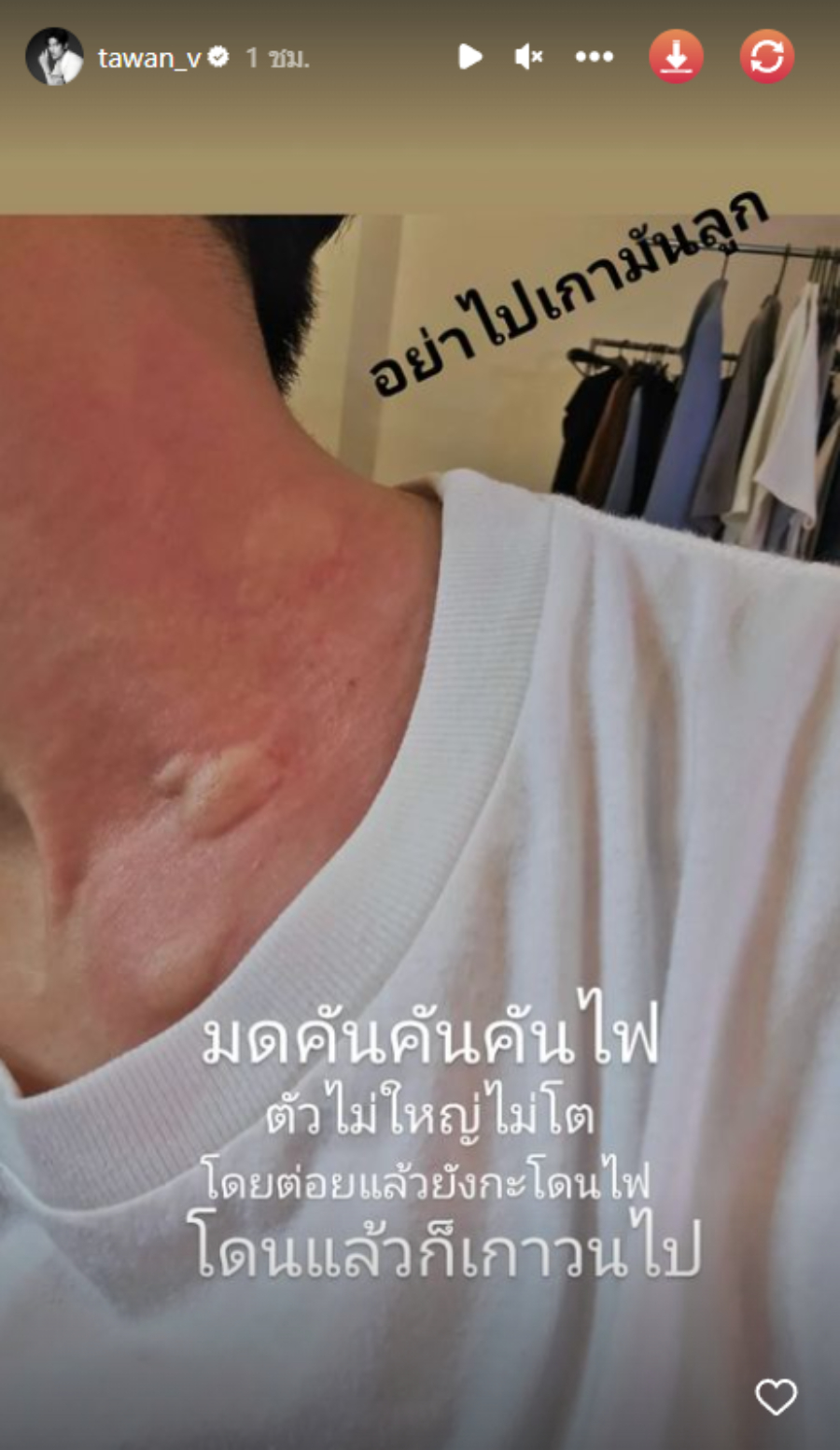 เต ตะวัน ถูกมดกัด