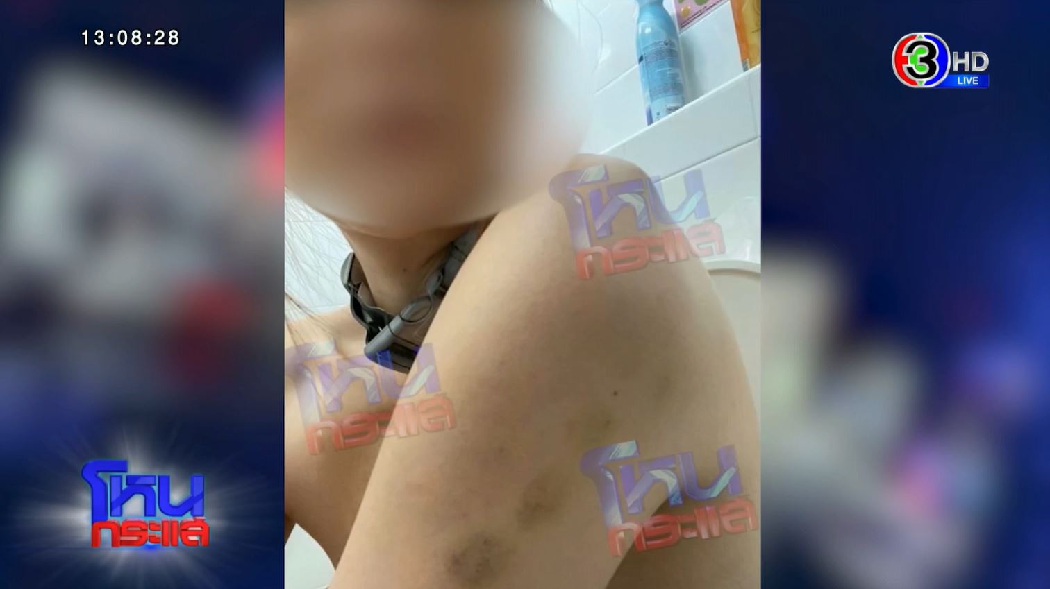 บาดแผลดิวถูกทำร้ายร่างกาย