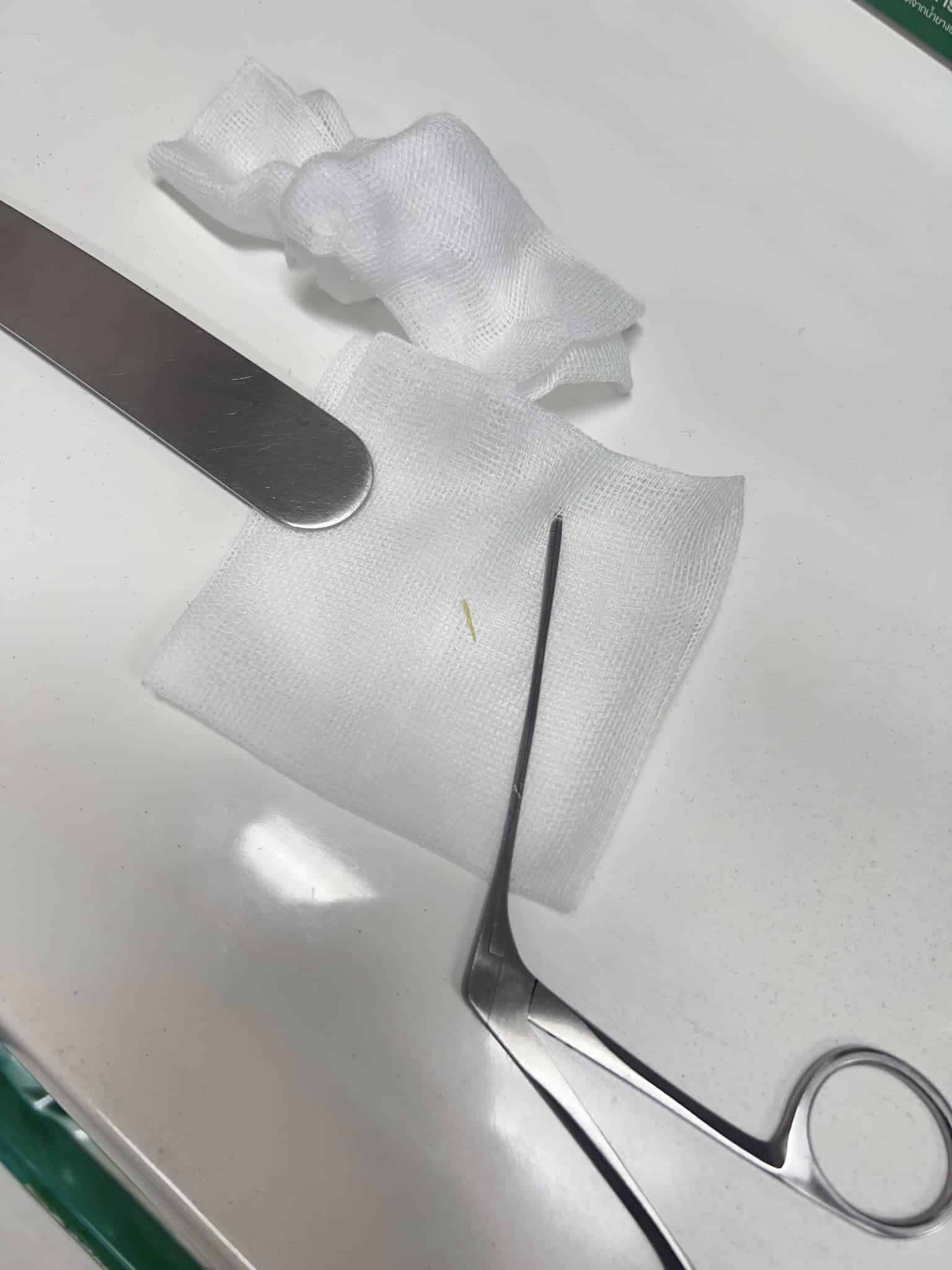 ภาพข่าว ก้างติดคอ