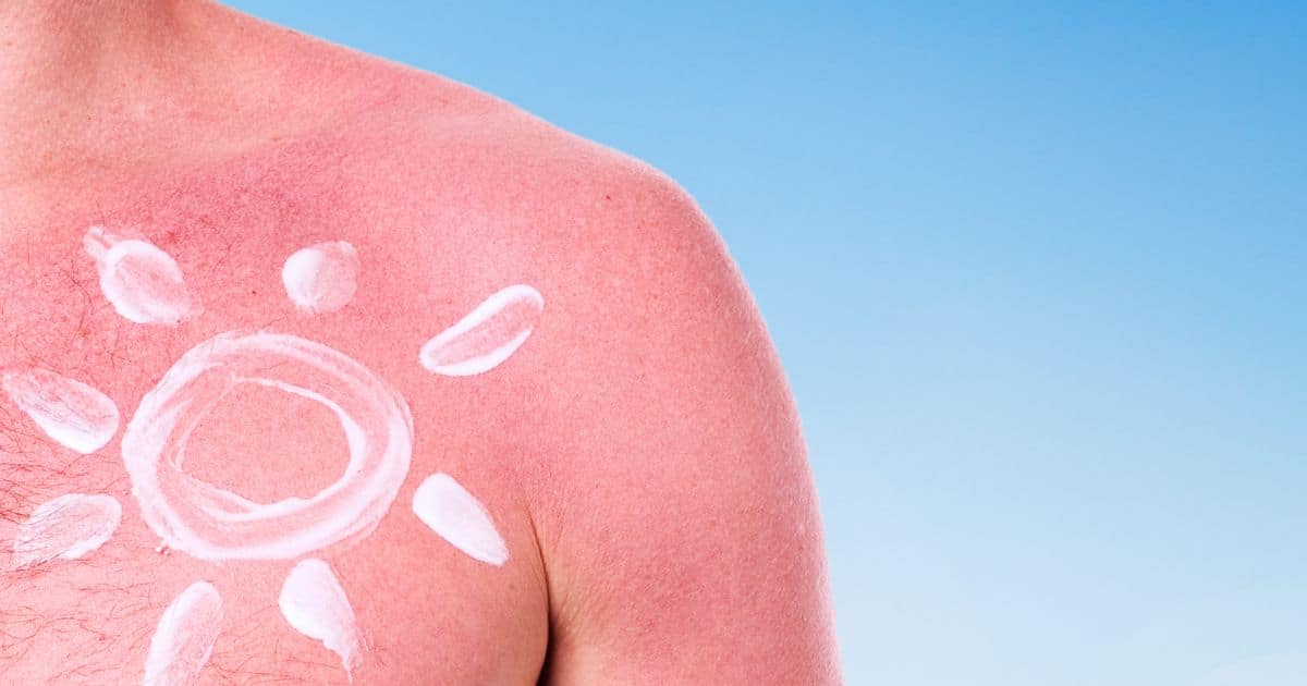 โรคหน้าร้อน ผู้สูงอายุ