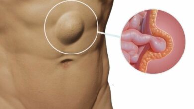 ไส้เลื่อน