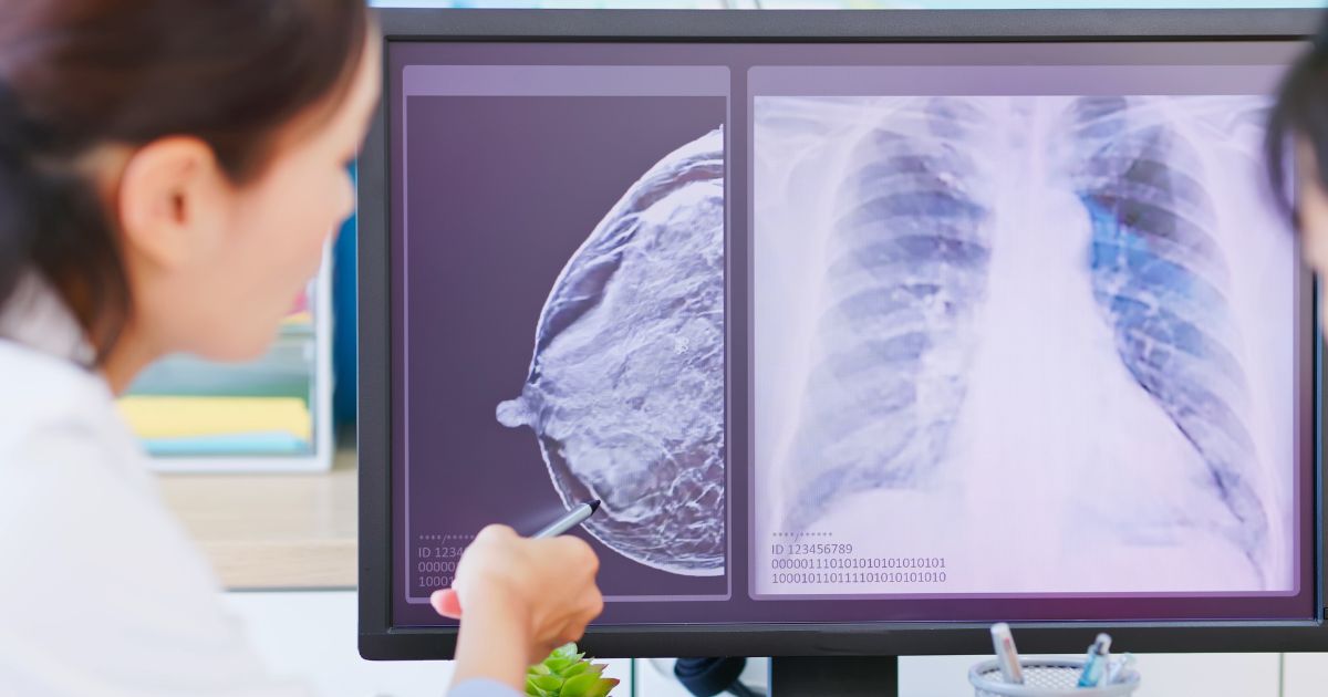 ประกันมะเร็ง FWD Easy E-Cancer ก่อนซื้อควรคำนึงถึงอะไรบ้าง