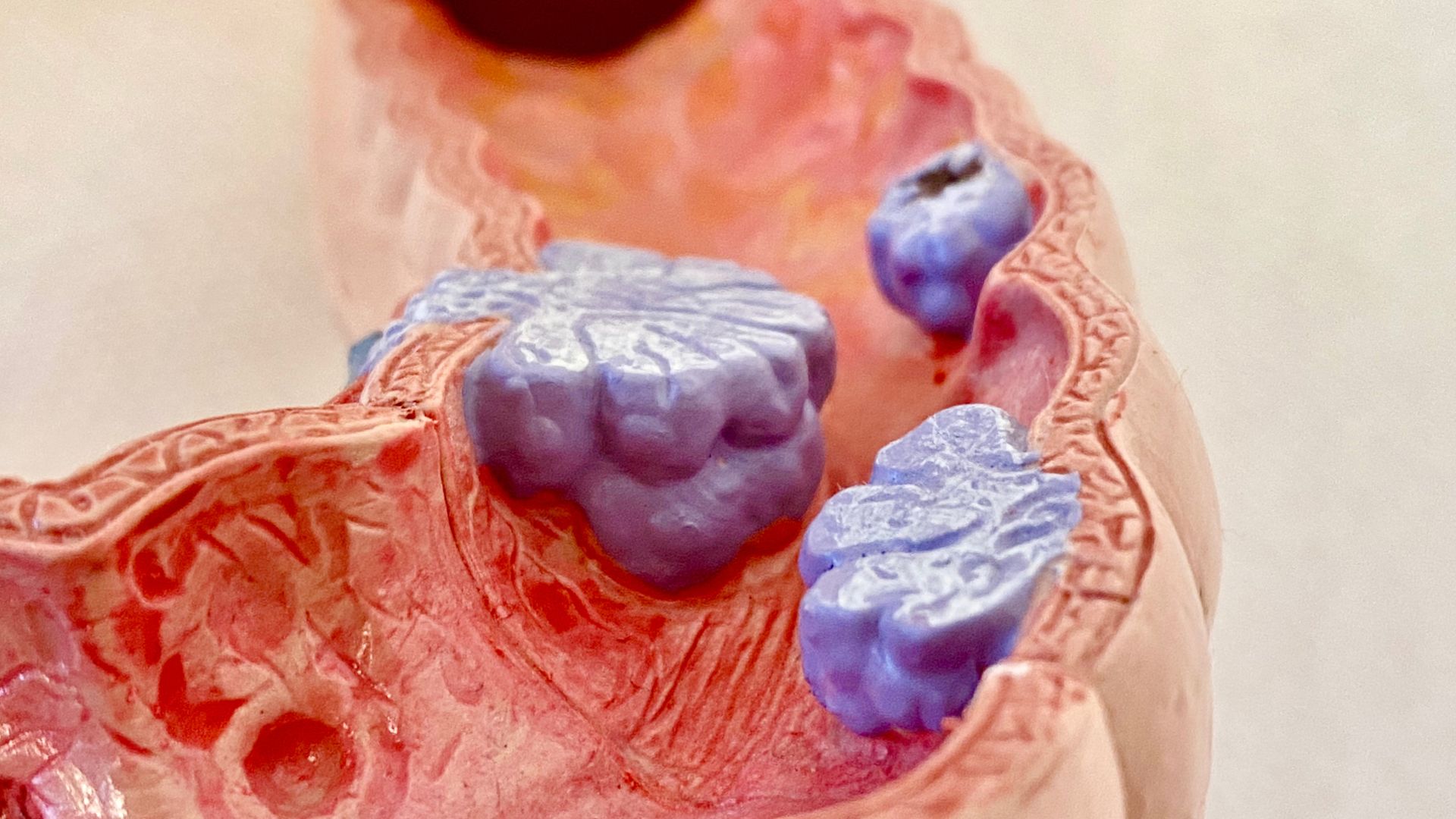 มะเร็งลำไส้ใหญ่