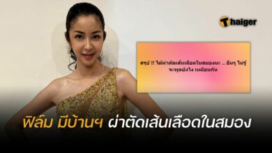 ﻿ฟิล์ม มิสทิฟฟานี่ ผ่าตัดเส้นเลือดในสมอง