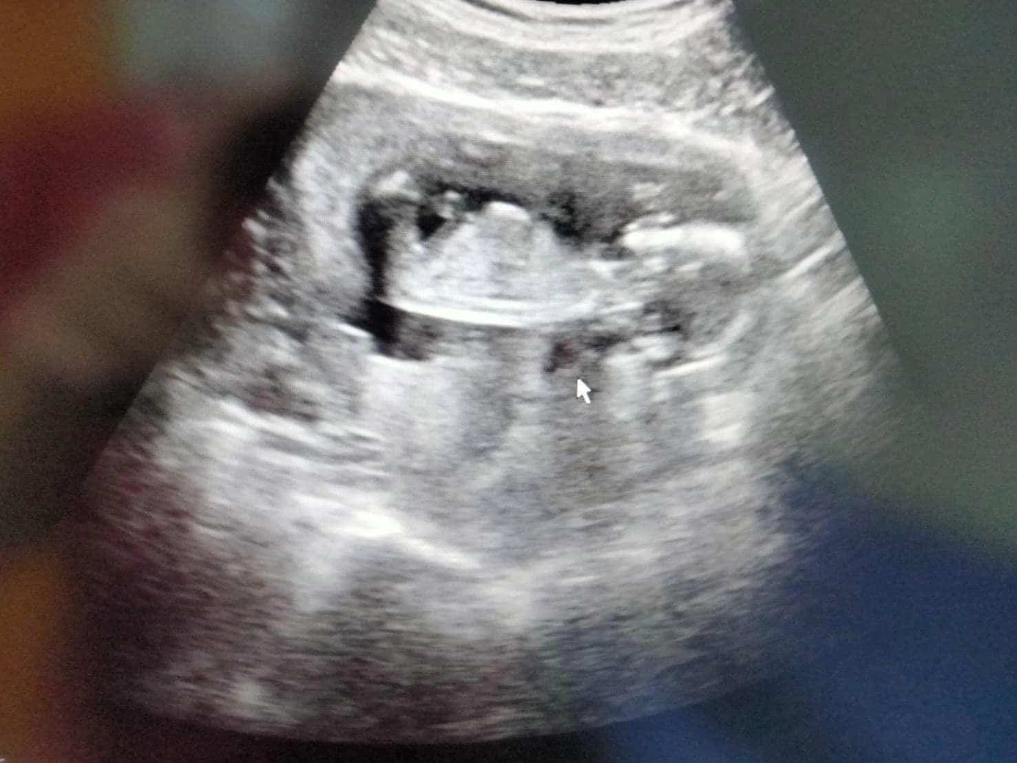 ภาพอัลตราซาวด์ โสรยา พรมหล้า