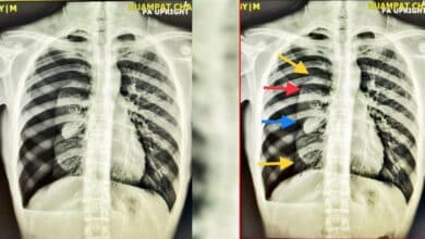 บุหรี่ไฟฟ้าอันตรายไหม