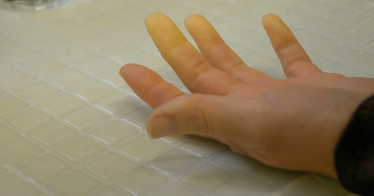 โรคผิวหนังแข็ง