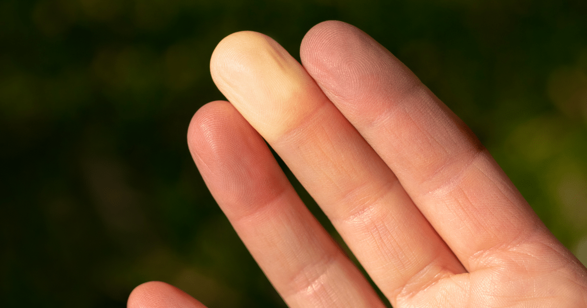 โรคผิวหนังแข็ง