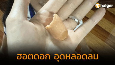 อุทาหรณ์ ลูกสาวรับประทานฮอตดอก อุดหลอดลม โชคดี คุณแม่ช่วยเบื้องต้นได้