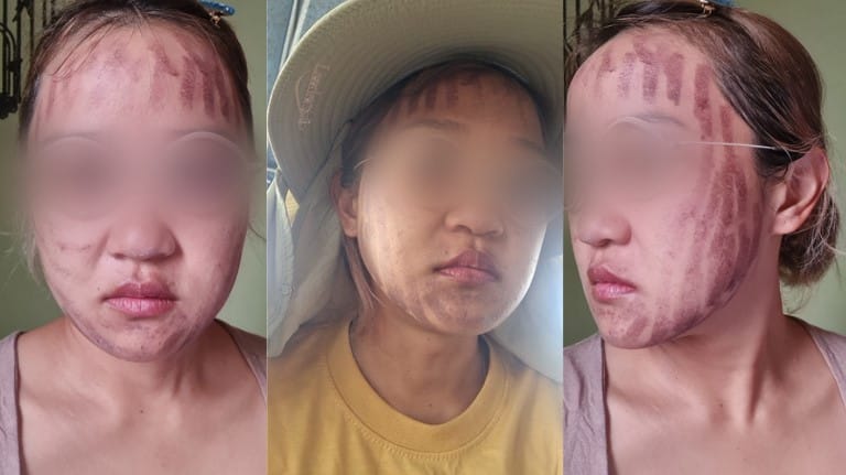 คลินิก หน้าไหม้