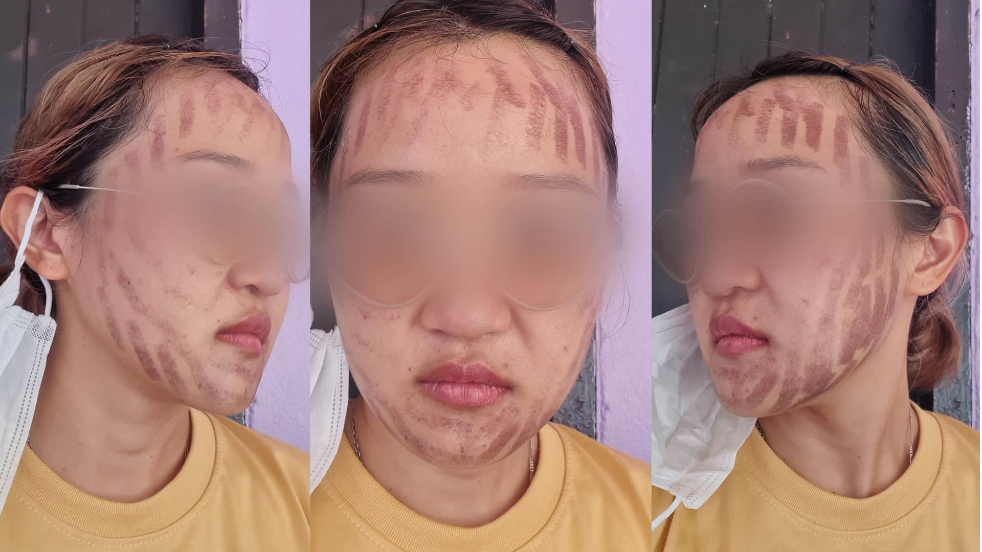 คลินิก หน้าไหม้