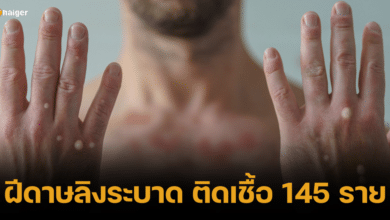 "ฝีดาษลิง"ระบาดหนัก! ส.ค. ติดเชื้อเพิ่ม 145 ราย เด็กสุด 16 ปี