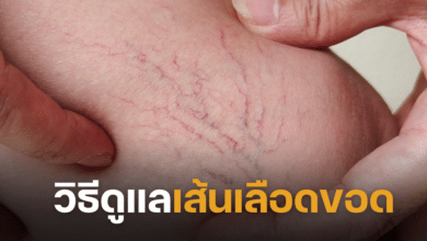 วิธีดูแลเส้นเลือดขอด