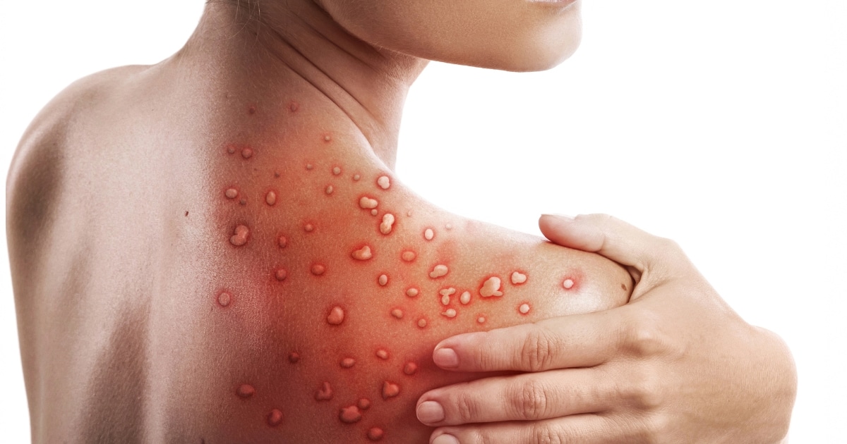 สาเหตุฝีดาษลิงระบาดหนัก