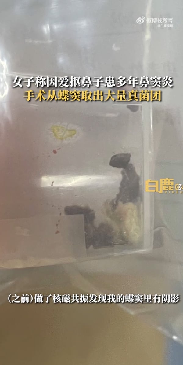 หญิงจีนมีเชื้อราในจมูก