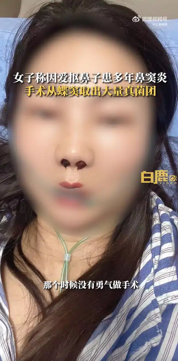 หญิงจีนมีเชื้อราในจมูก