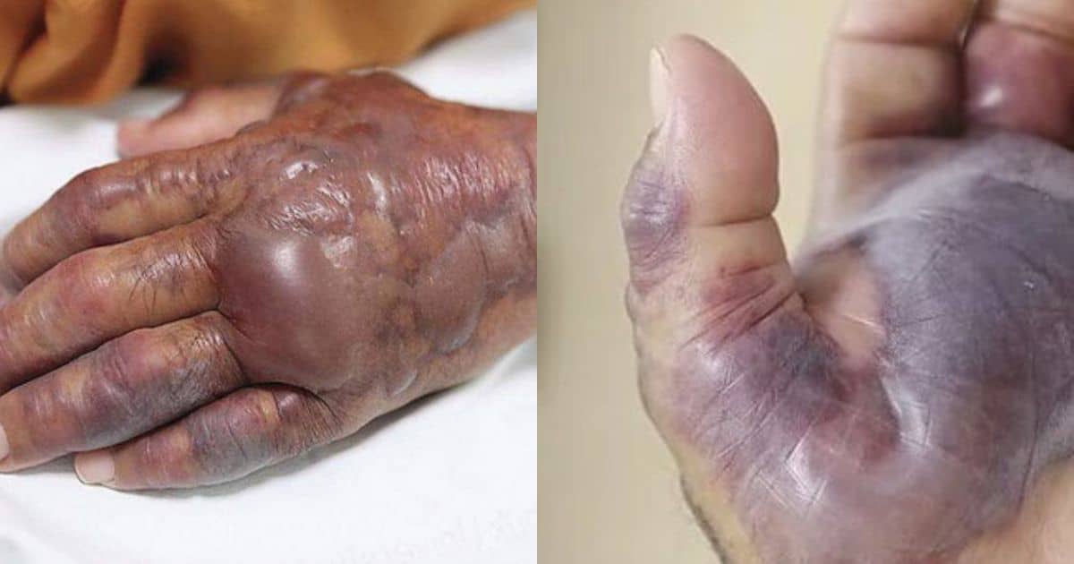 แบคทีเรียกินเนื้อ