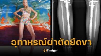 ปกนางแบบผ่าตัดยืดขา