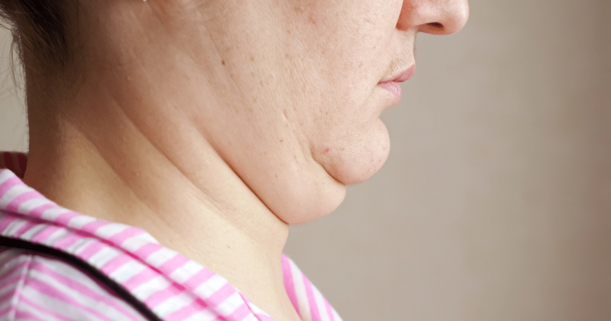 วิธีลดเหนียงคอ ทำอย่างไรให้เหนียงหาย คืนความงามให้ใบหน้า ไม่ว่าใครก็หน้าเรียวได้