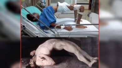 โรคบาดทะยัก