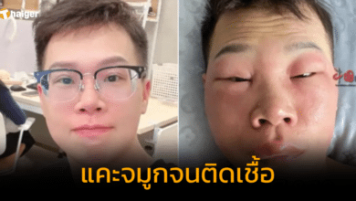 หนุ่มจีน แคะจมูกบ่อย จนหน้าบวมแดง ลืมตาไม่ได้ แพทย์คาดสาเหตุ เกิดจาก &quot;ไฟลามทุ่ง&quot; 