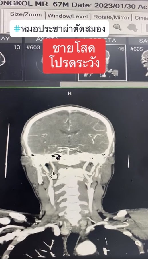 ดื่มแอลกอฮอล์หนักเสี่ยงเส้นเลือดสมองอุดตัน